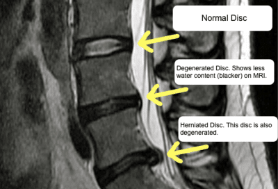 Normal disc versus degenerated disc and herniated disc